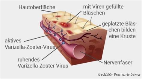 G Rtelrose Ansteckung Symptome Netdoktor Ch