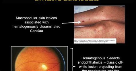 Invasive Candidiasis - Health And Medical Information