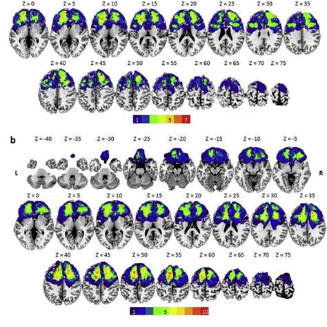 Lesion Distribution Volume Map For All Patients Used In The Pslm