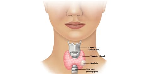 Thyroid lumps and nodules - Thyroid Sydney