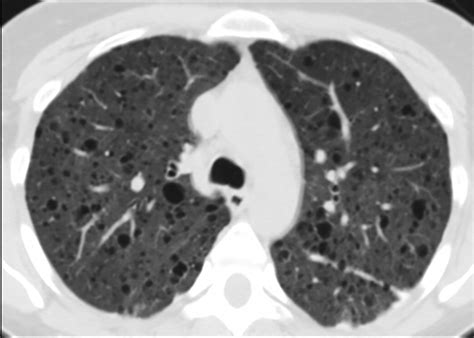 Comprehensive Imaging Manifestations Of Tuberous Sclerosis Ajr