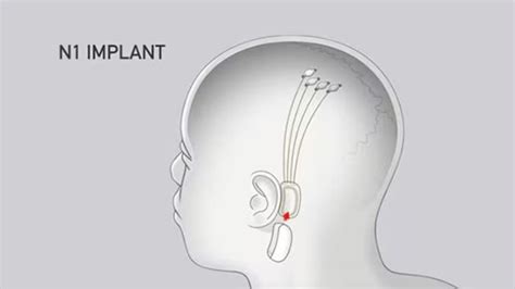 How Elon Musks Neuralink Brain Chip Works Fox News