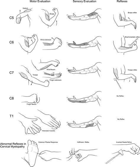 Cervical Radiculopathy And Myelopathy Presentations In The Hand