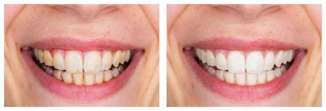 Yellow Teeth? Teeth Whitening in Denver to the Rescue! - Pearl ...