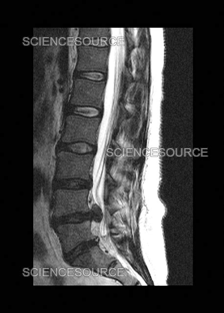 Photograph Large Herniated Lumbar Disc Mri Science Source Images