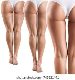 Female Buttocks Before After Cellulitis Zdj Cie Stockowe Edytuj Teraz