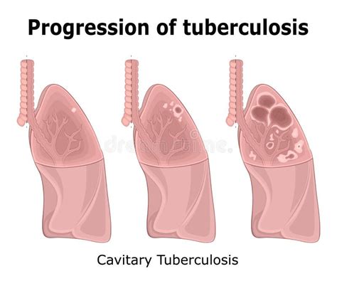 Tuberculose Stock Illustrations Vecteurs And Clipart 9270 Stock