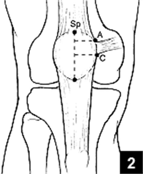 Medial Patellofemoral Ligament Anatomy