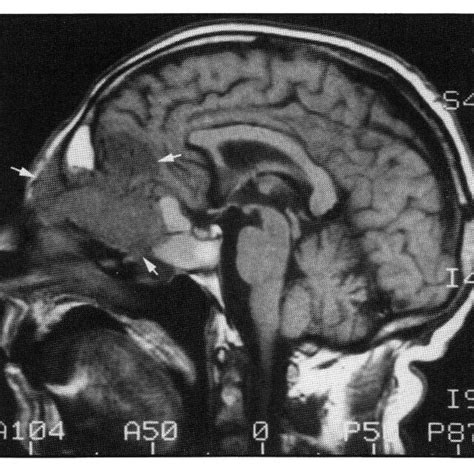 -MRI scan Tl weighted image, coronal section through anterior fossa ...