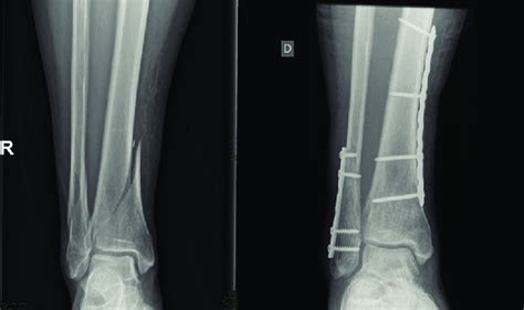 Distal Tibia Fracture Treated With Lag Screws And Antiglide Plate