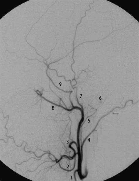 External Carotid Artery Branches Angiogram