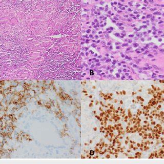 Lymph node biopsy. Lymph node biopsy showing extensive non-necrotizing ...