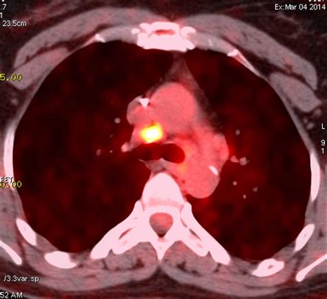 Mediastinal Lymph Nodes CT Scan