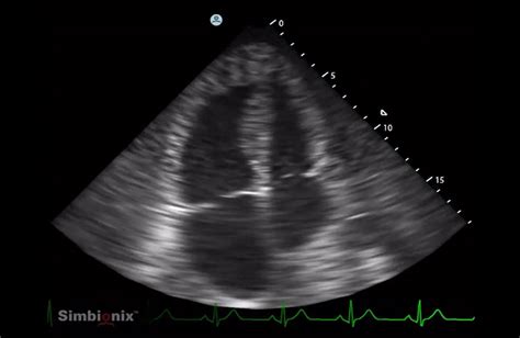 US Bedside Echocardiography | Simbionix