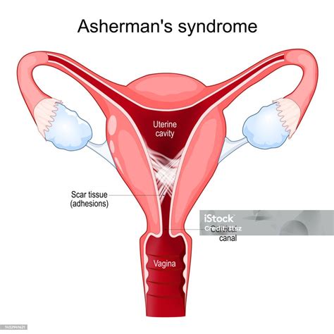 Ashermans Syndrome Cross Section Of Uterine With Adhesions Stock