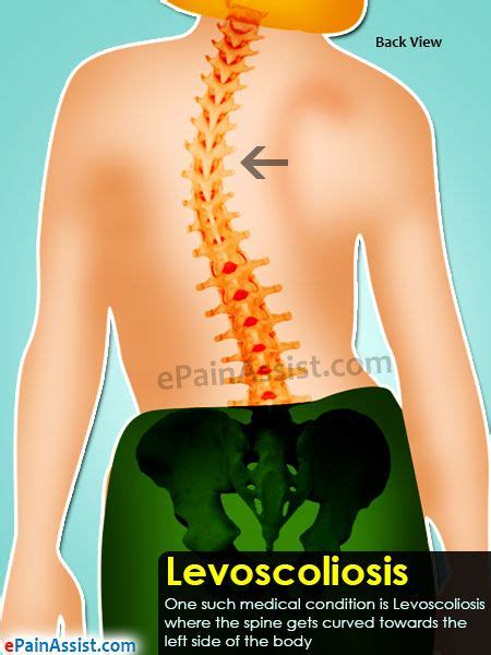 Ipl Skin Treatment Levoscoliosis Lumbar Spine Treatment