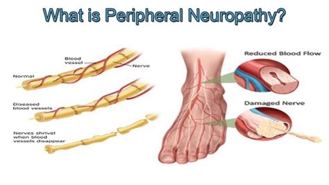 Neuropathy Treated in Great Falls | Loebig Wellness and Chiropractic