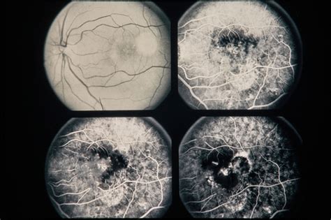 Central Serous Retinopathy - Retina Image Bank