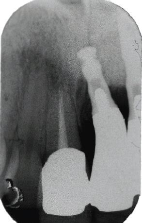 Preoperative Clinical And Radiographic Views A Buccal Aspect B