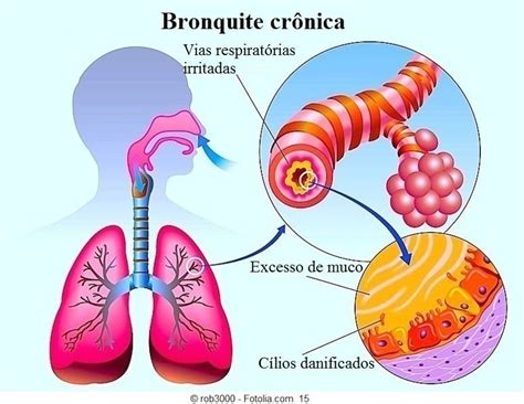 Sintomas Da Bronquite Aguda Ou Cr Nica Tratamento E Rem Dios Naturais