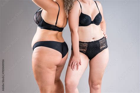 Two Overweight Women With Cellulitis Fat Flabby Bellies Legs Hands