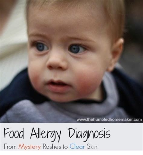 Food Allergy Diagnosis: From Mystery Rashes to Clear Skin