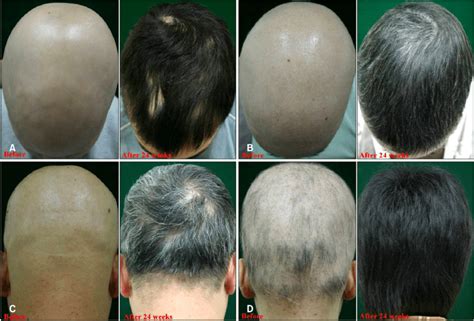 Alopecia Universalis Treatment