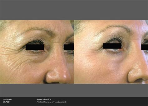 Co2 Fractional Laser Skin Resurfacing Newport Medical And Wellness Center