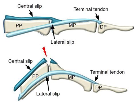 Central Slip Extensor Tendon Injury Wiki Sports Medicine R Orthopaedics