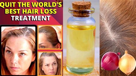 How I Quit The World’s Best Hair Loss Treatment And Regrew My Hair Naturally Hair Regrowth Youtube