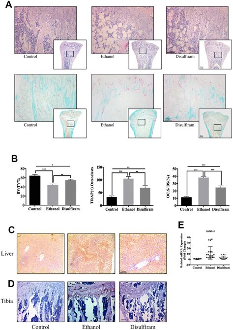 Disulfiram Suppressed Ethanol Promoted RANKL Induced Osteoclastogenesis