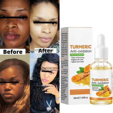 Dark Skin Permanent Whitening Lightening Brightening Bleaching Turmeric