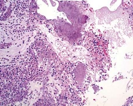 Actinomycosis Histology