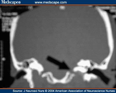 Mri Brain: Mri Brain Orbits Cpt Code