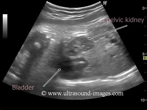 Wk 5 L 2 Genitourinary Renal Ectopia Ultrasound Image Of Fetal Pelvic