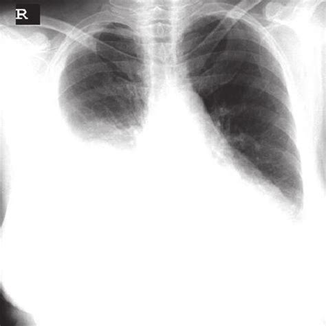 Posteroanterior Chest X Ray Showing Pleural Effusion In The Right