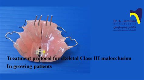 Treatment Protocol For Skeletal Class III Malocclusion In Growing