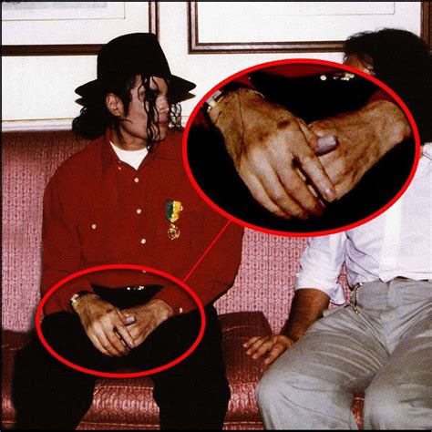 Vitiligo Michael Jackson Michael Jackson News Comic Vine