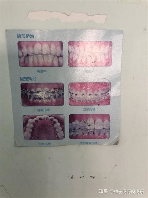 坐标杭州，记录一下省口看牙经历（正畸补牙洗牙根管） 知乎