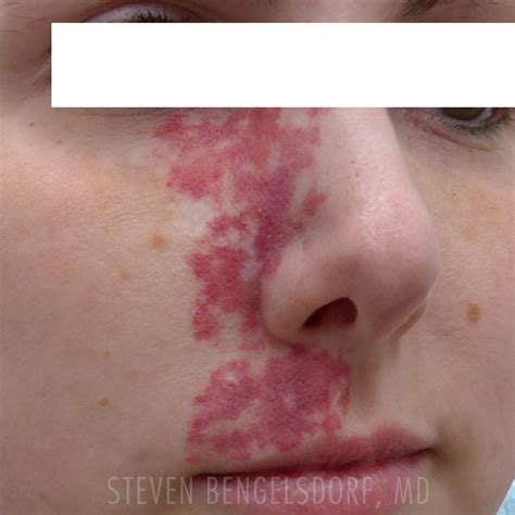 Birthmark Removal Franklin Tn Port Wine Stain Franklin Tn