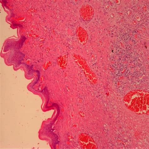 Stratified Squamous Epithelium With Underlying Scattered Thin Walled