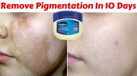 Vaseline To Remove Skin Pigmentation Dark Spots Acne Scars Easily At