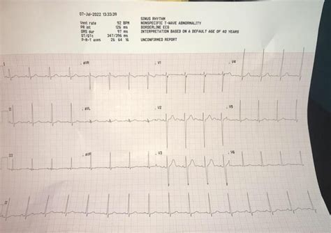 Ekg Nonspecific T Wave Abnormal Rekg