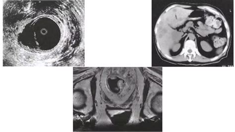 Carcinoma Rectum And Anal Canal Pptx