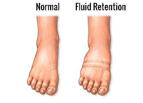fight fluid retention healthy habits step  health
