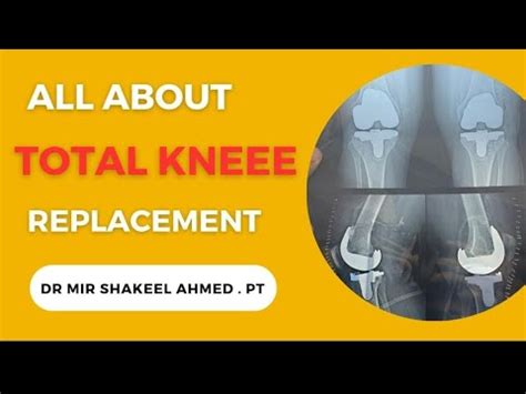 TOTAL KNEE REPLACEMENT TKR TKA REHABILITATION PHYSIOTHERAPY PROTOCOL