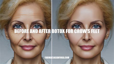 Before And After Botox For Crows Feet A Comprehensive Guide