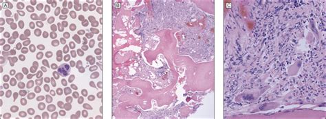 Primary Myelofibrosis And The Myeloproliferative Neoplasms The Role Of