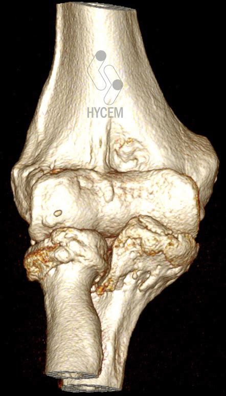 Artrosis De Codo Hycem