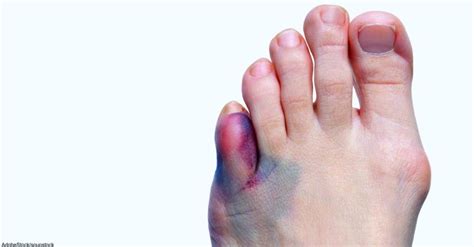 Why Are My Feet Purple Causes Of Foot Discoloration You Should Know